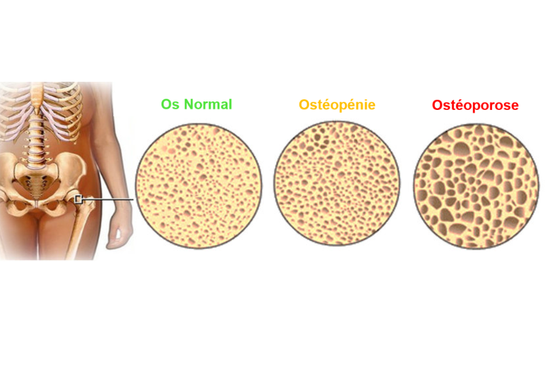 Ostéopénie : la grande oubliée du vieillissement osseux 